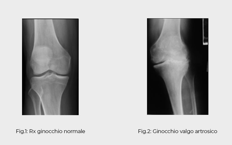 Differenza RX ginocchio normale e Ginocchio valgo artrosico